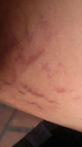 大腿内侧两边都长了这些红色条纹血丝,不痛不样