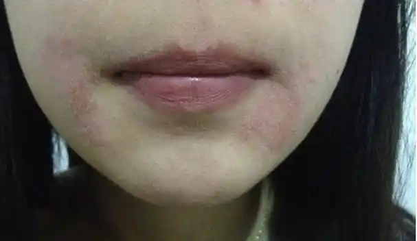 银屑病长在脸上影响颜值,怎么办?