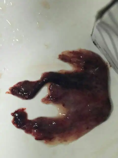 自然流产了怎么办现在还在出血,跪求了