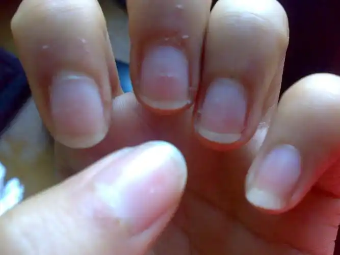 手指甲上经常出现一些白点,如下图.