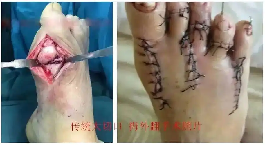 如何正确认识关节镜微创拇外翻手术