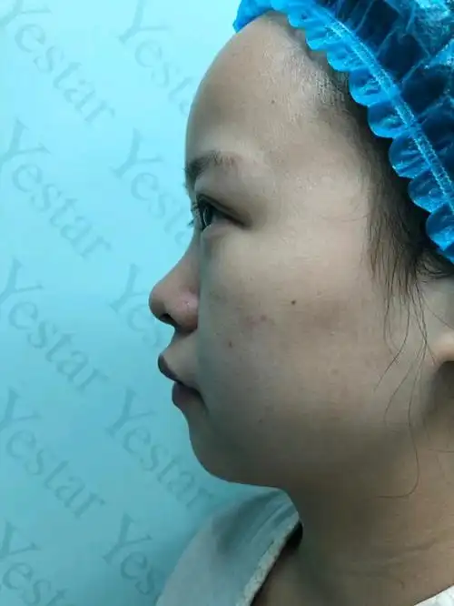 什么是扁凹鼻大概就是我这种吧鼻子很塌山根几乎没有整体塌陷不起我