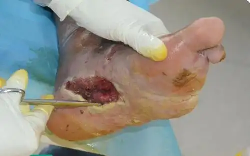 我们通常只看到的是烂脚创面的感染,可深不知,除了烂脚创面存在的感染