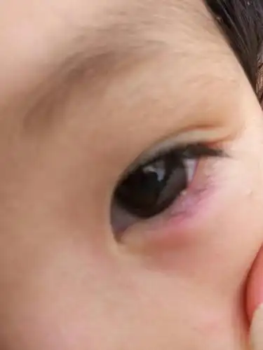 妞妞四岁半了,前天起床的时候,发现左眼,眼睛红红的,下午看了看,发现