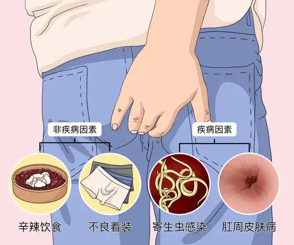 痔疮好了肛门瘙痒是怎么回事.jpg