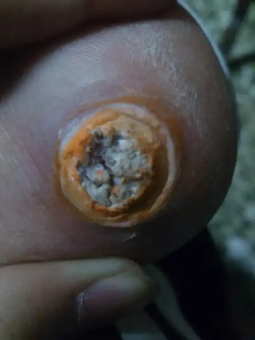 脚后跟长了个包,不清楚是鸡眼还是跖疣,一直按照鸡眼