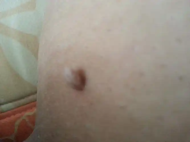 大腿上长了一个小肉丁很久了,不痛不痒的,不知道是什么啊.