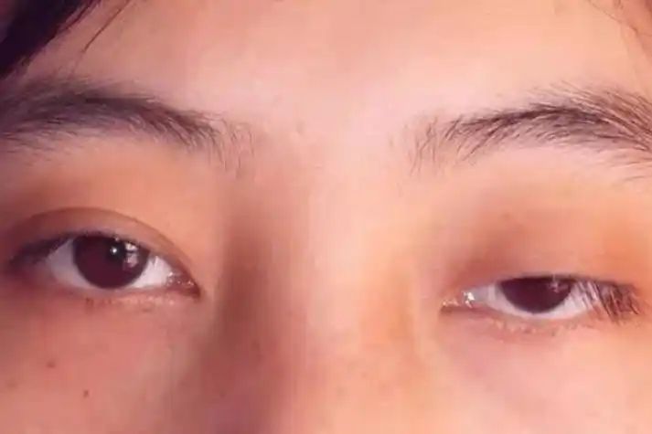 上眼睑提肌无力图