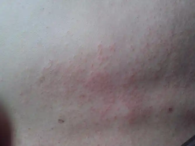 我爸爸背上起了一大片小红疙瘩,很痒,求助,有图_百度知道