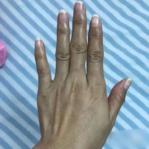 手部皮肤黑怎么变白跟着成功人的脚步准没错