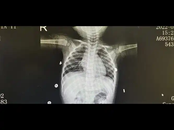 女童未及时就医诊断小儿支气管肺炎联合用药得以缓解