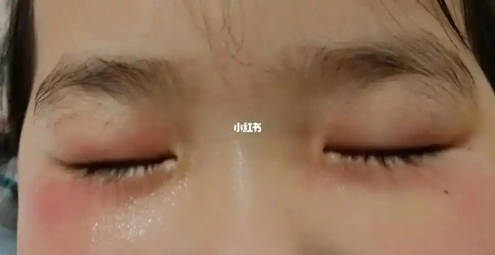 宝宝眼皮红肿涂红霉素眼膏一晚就好了