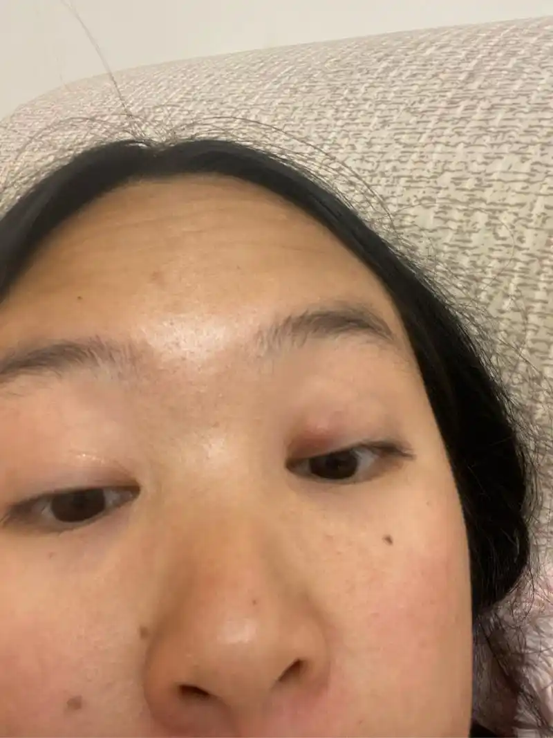 眼皮里面长了一个圆疙瘩怎么办 一个星期了一开始是红有点疼,眼睛睁不