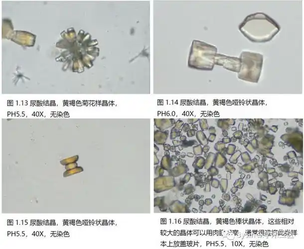 高清图谱尿液结晶形态汇总