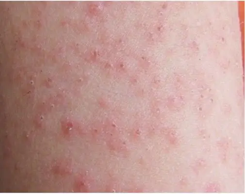 热疹图片9