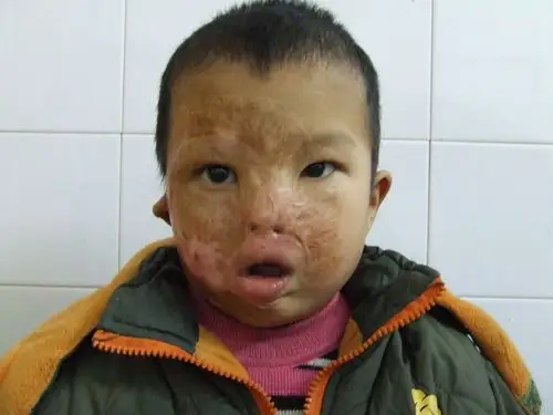 讨论面部烫伤后疤痕挛缩畸形手术方案