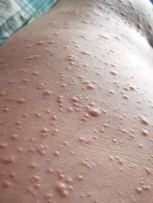 怀孕长湿疹,实在太难受了