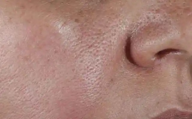 毛孔粗大不仅影响美观,还影响皮肤的健康,注重日常护肤很重要