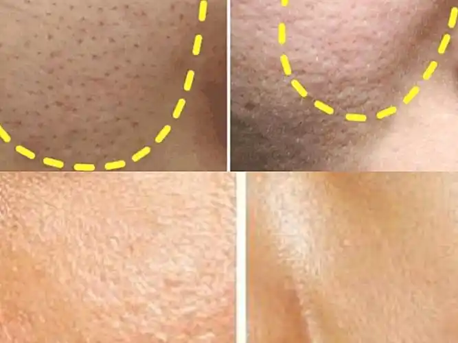 93毛孔粗大的问题真的是许多爱美人士的困扰,尤其夏日_圈子-新氧