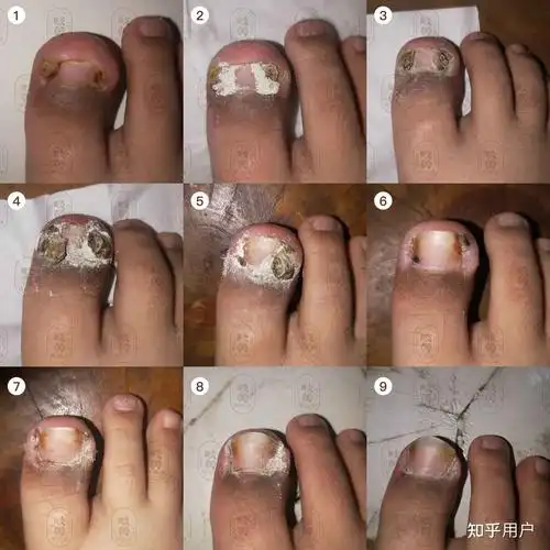甲根炎怎么治疗? - 知乎