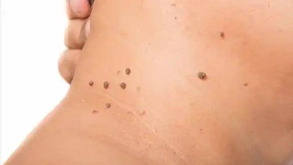 身上脖子上反复长尖尖的丝状疣一颗能发展多颗传染性很强