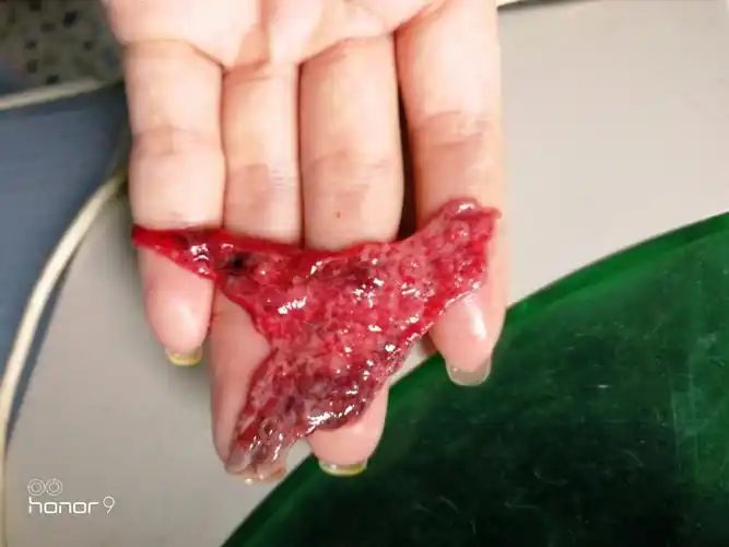 孕7周先兆流产排出黑色血块