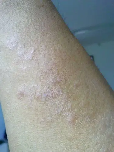 这是什么皮肤病,不痛不痒