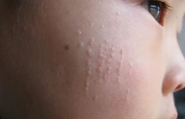 眼睛周围长的小颗粒,到底是什么?
