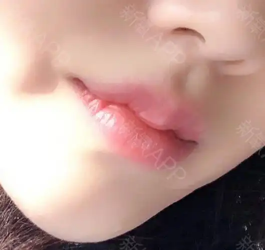 过了两天了,嘴巴消肿了一点点,现在真的是嘟嘟_圈子-新氧美容整形