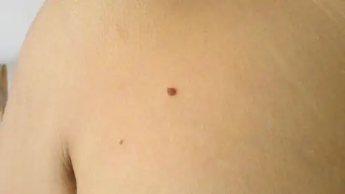 最近身上长出两个小肉球