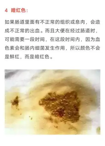 黑便,奶瓣,绿便,腹泻,便秘.宝宝的各种便便真图全解!建议收藏
