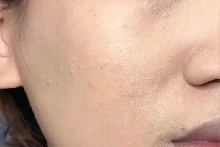 (卡粉)冬天比夏天更难上妆这就是皮肤干燥造成的皮肤缺水会造成角质层