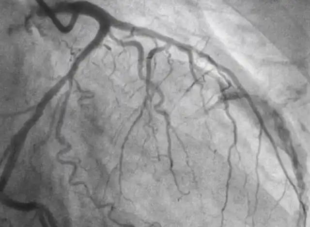 什么人要做血管造影?