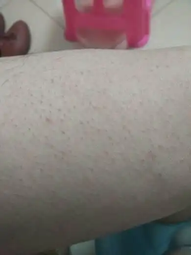 我老公腿上毛孔堵塞了,有谁也会这样?怎么才能好?