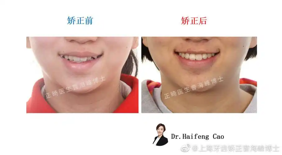 牙齿拥挤有虎牙矫正案例原创