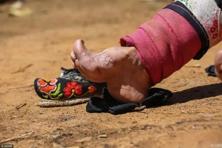 实拍最后的"裹足老人" "三寸金莲"脚掌已变形