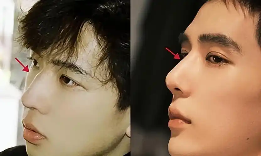 从前鼻梁上有驼峰,正面鼻背宽,鼻子量感大,看起来很粗糙.