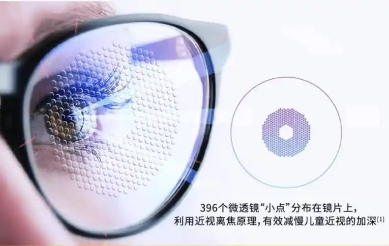 青少年近视防控黑科技杭州仁树医疗眼科专家张洪勋详解离焦镜