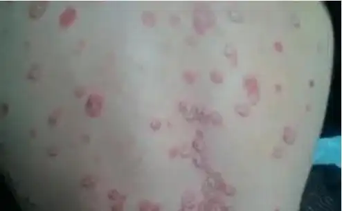 长沙专业治疗鱼鳞病医院,治疗好不好?_鳞屑_多种类型_边缘