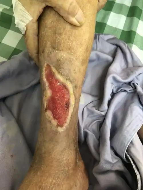 老人小腿外伤皮肤坏死,非手术愈合 - 好大夫在线