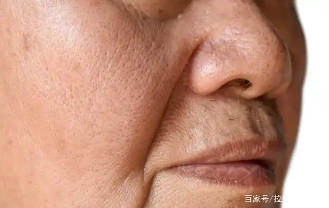 法令纹又称鼻唇沟纹,是由于皮肤组织老化松弛造成面部肌肤表面凹陷