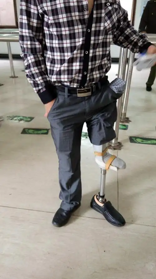 世界罕见的小腿双畸形假肢案例湖南佳满假肢