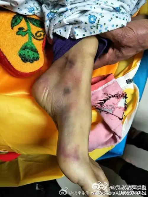 所有损伤在一个平面上,表皮轻而出血区域大,符合坠落的垂直外力作用