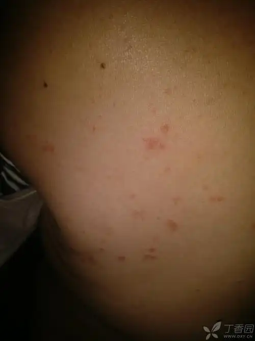 皮肤瘙痒红疹 [病例帖]