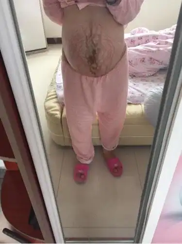 双胞胎.肚子发偏怎么办?