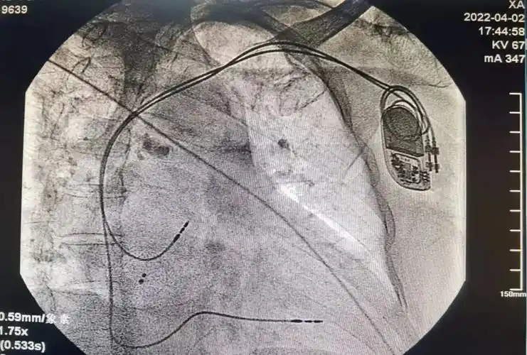 先行肘静脉造影清楚显示腋静脉,在x线指导下顺利穿刺成功,用时1小时