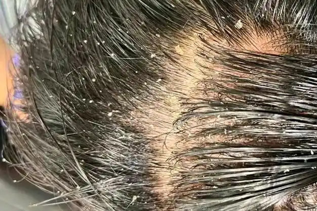 掉发多出油快头皮痒就用这几款育发产品好得更快