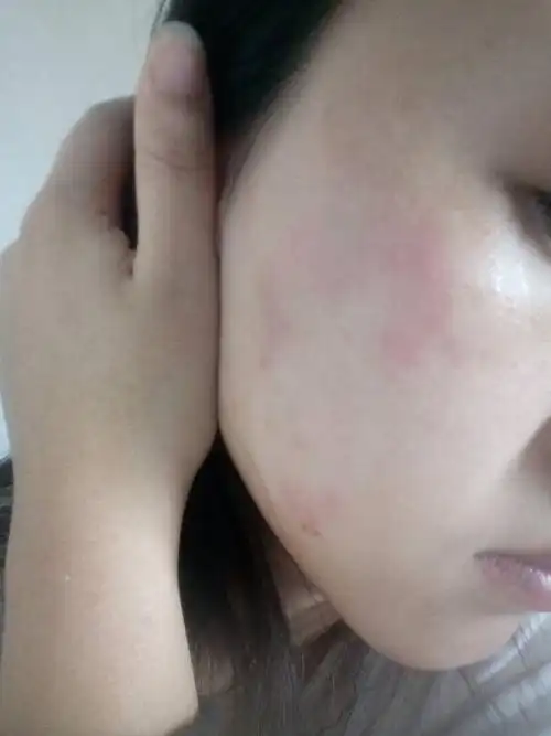 8491lv15 擅长:两性问题 向ta提问私信ta  展开全部 是不是化妆品过敏