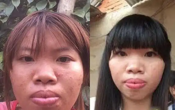 越南女子kim太丑没人娶 花10万整容嫁富二代 娶个越南女孩多少钱