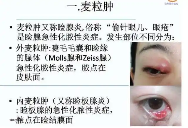 麦粒肿和霰粒肿的个体化分期治疗